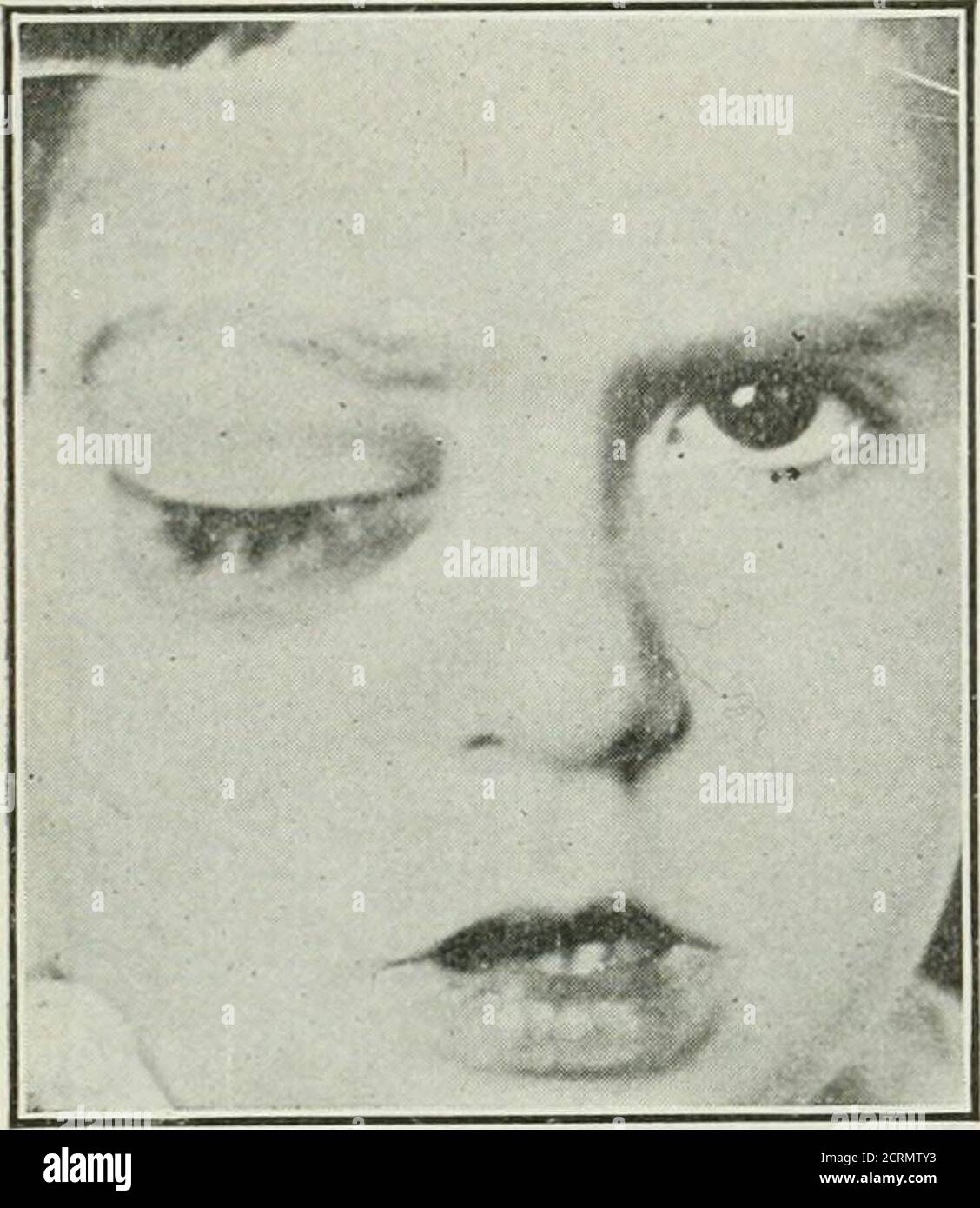 . Radium . B Fig. S.—A, basal cell epithelioma of the dorsal surface of hand involving tendonsand bloodvessels and adherent to bone. Patient aged 76. Referred by Dr. H. B.Baxter, Philadelphia. B, retrogression without great impairmem: of motion ofthe hand after radium needle treatment. This did not heal completely and finallyamputation was done to guard against metastasis upon the advice of the attend-ing surgeon. time just too short to kill the tumor cells caused a marked slowing inthe growth of the cells. They cannot explain the variability in lethalaction of the rays except to say that it i Stock Photo