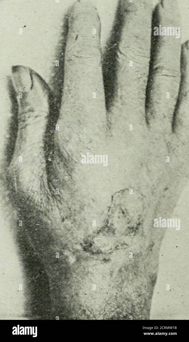 . Radium . B Fig. S.—A, basal cell epithelioma of the dorsal surface of hand involving tendonsand bloodvessels and adherent to bone. Patient aged 76. Referred by Dr. H. B.Baxter, Philadelphia. B, retrogression without great impairmem: of motion ofthe hand after radium needle treatment. This did not heal completely and finallyamputation was done to guard against metastasis upon the advice of the attend-ing surgeon. time just too short to kill the tumor cells caused a marked slowing inthe growth of the cells. They cannot explain the variability in lethalaction of the rays except to say that it i Stock Photo