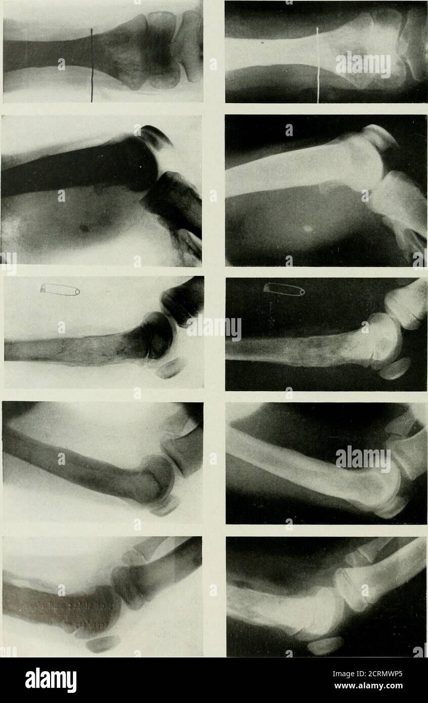 . Radiography and radio-therapeutics . PLATE XXXVI. — FiJACTrRKS of Lkg ...