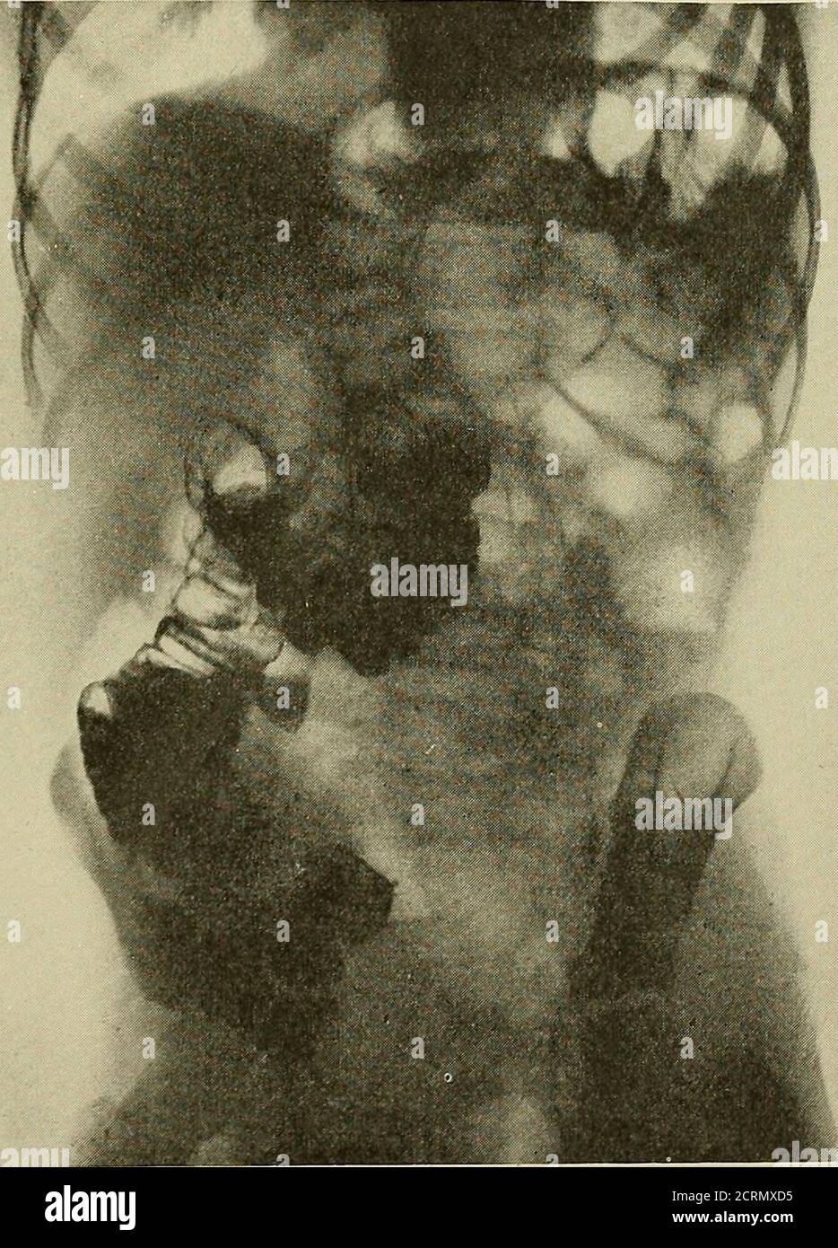 Splenic flexure hi-res stock photography and images - Alamy