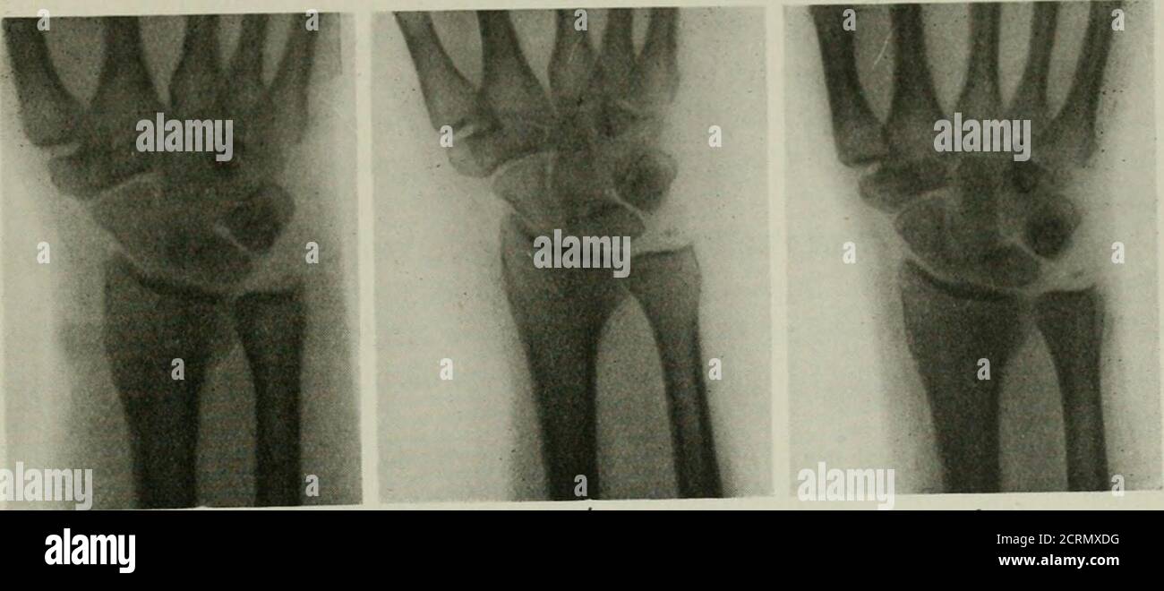 . Radiography And Radio-therapeutics . Plate Xxx—fractures At The Anki 