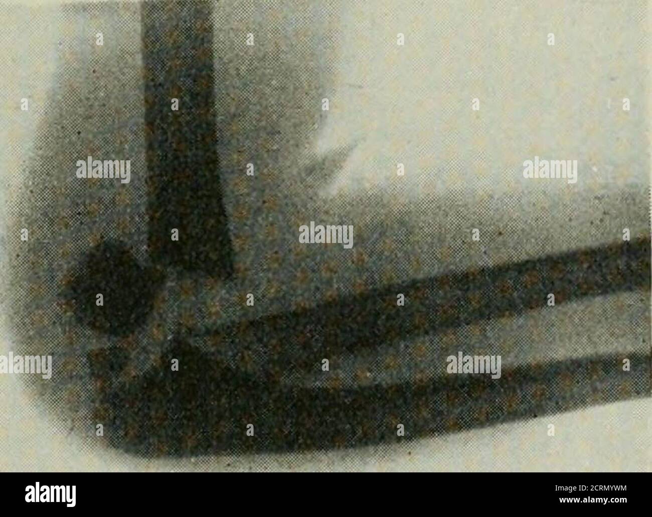 . Radiography and radiotherapeutics . Fig. 216.—Fracture of shaft of humerusand upper end of