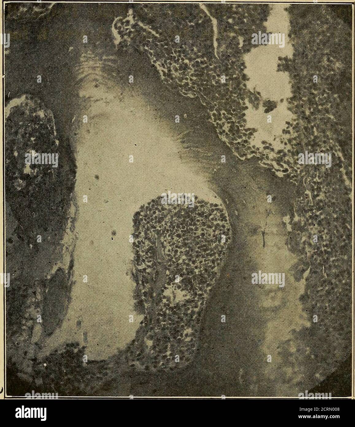 . Diseases of bones and joints . Fig. 93. Skiagram of bone shown in Fig. 6. Diagnosis, sarcoma. symptoms and physical signs of this disease willmake the nature of the process evident. The bonelesions of tabes are almost invariably painless.Benign Myeloma. From the fact that this disease 216 DISEASES OF BONES AND JOINTS has been included hitherto with sarcoma, the differ-ential diagnosis is still somewhat obscure. It usuallyoccurs in the metaphysics of the long bones. Egg-shell crackling is frequent over it. It is prob-ably slower in its growth than is sarcoma, anddoes not break through into th Stock Photo