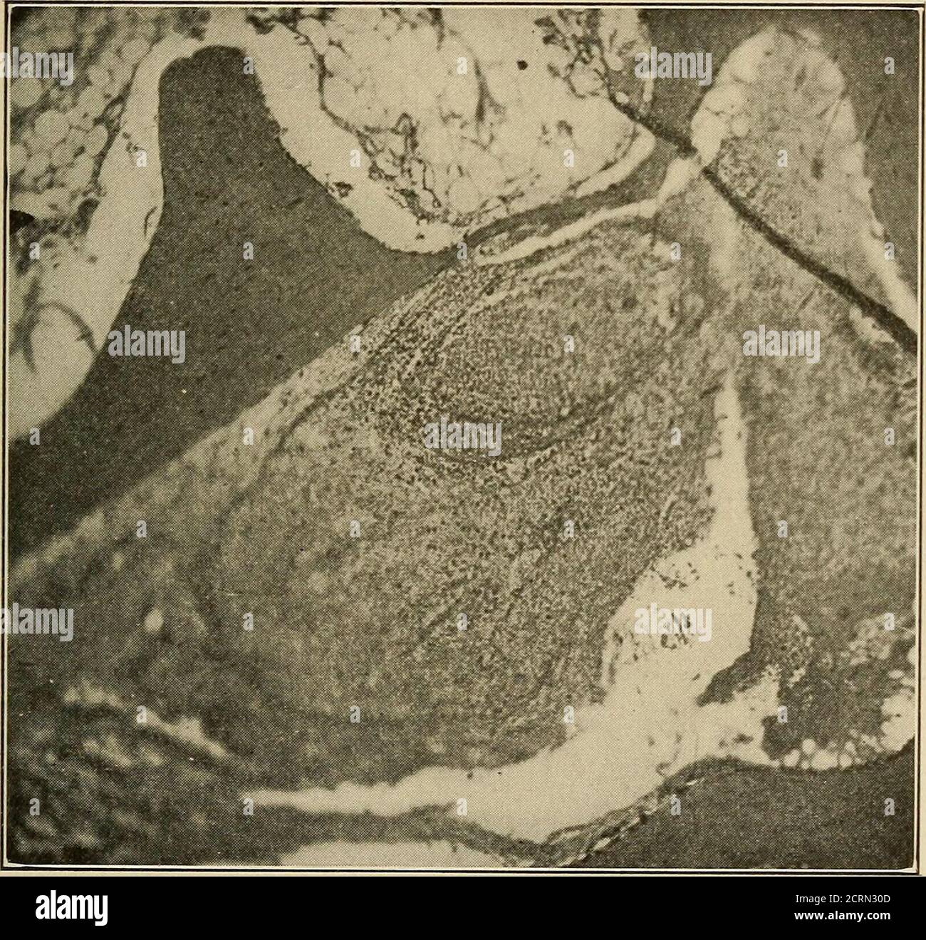. Diseases of bones and joints . Fig. 53. Photomicrograph of synovia