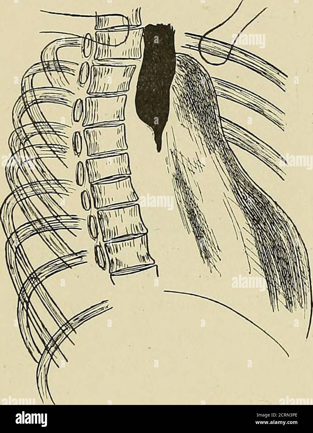 Radiography and radio-therapeutics . aphy)should always be employed in  these cases. Compression Stenosis of the (Esophagus.—This may be the result  ofdisease in the vicinity of the oesophagus. The most frequent causes