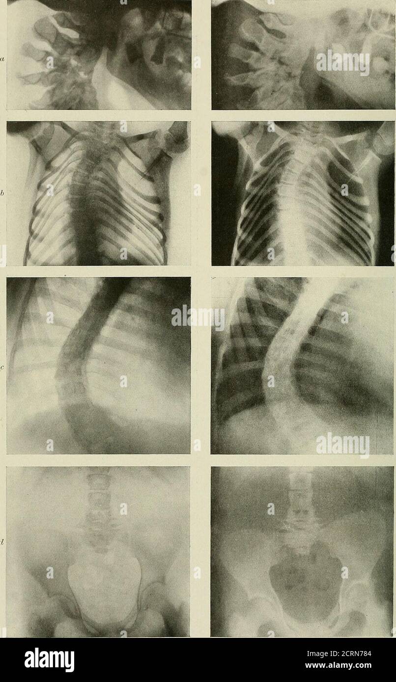 Radiography and radio-therapeutics . PLATE XLV.—Diseases and Curvature op  the Spine. a, Caries of cervical vertebrae, lateral view.b, Curvature of  upper dorsal spine (scoliosis).Curvature ol spine, involving lower dorsal  and lumbar