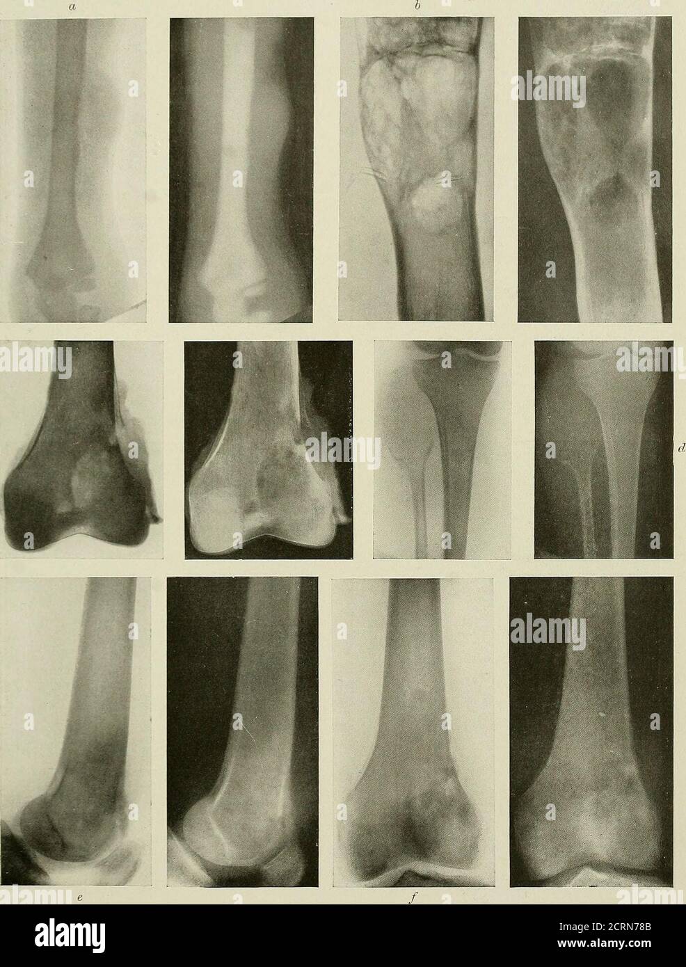 Radiography and radio-therapeutics . 234 show anumber of radiograms from a  case of this kind, where the earliest mani-festation of disease was seen in  the neck, below the epiphyseal line. Theclinical