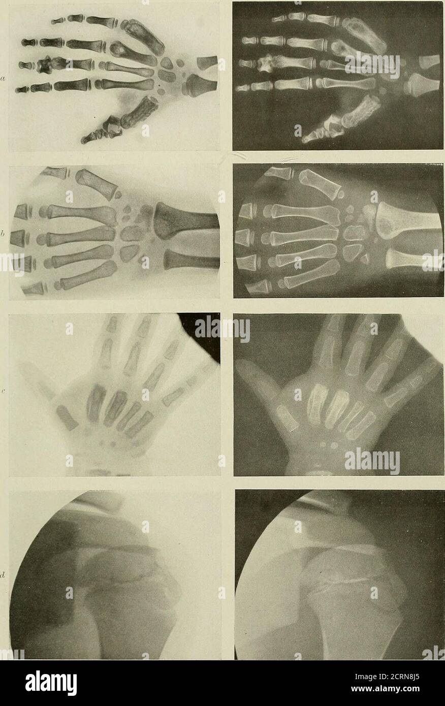 . Radiography and radio-therapeutics . Fig. 232.—View of the affected ...