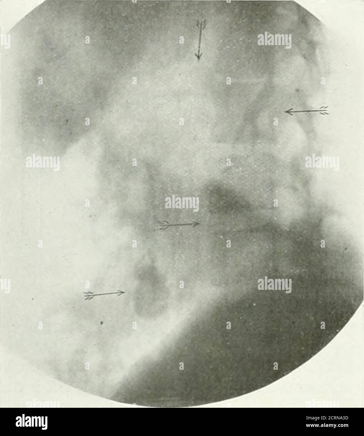 . The American journal of roentgenology, radium therapy and nuclear ...