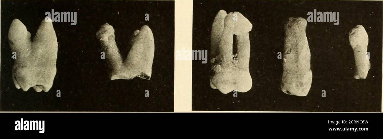 . Oral Roentgenology : a Roentgen study of the anatomy and pathology of the oral cavity . tion. Figure 141.Patient: Mrs. T. M. G. Roentgen Examination: Shows irregular outline of mesial root of first molar,a condition which indicates absorption due to chronic inflammation. Figure 142.Patient: Mrs. H. G. B. Roentgen Examination: Granulomata at the ends of the roots of the first molarare indicated by the radiolucent areas. The mesial root shows marked exostosis. Figures 143 and 145.Roentgen Examination: Shows in Figure 143 absorption of the palatal root ofthe upper first molar and in Figure 145 Stock Photo