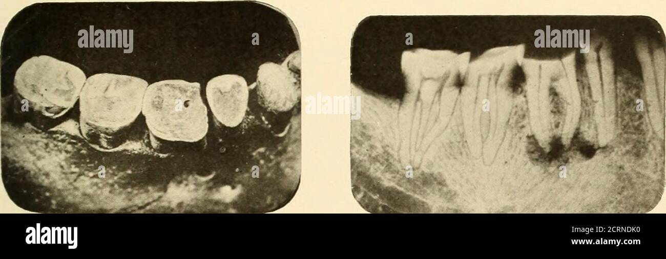 Osteoma hires stock photography and images Alamy