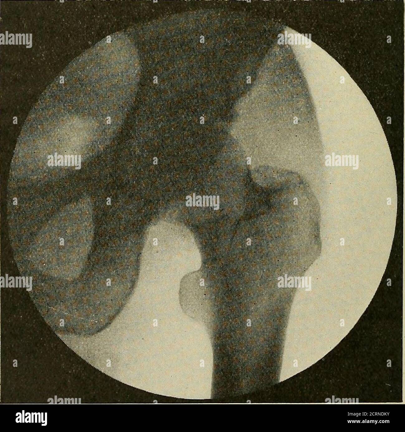 . Radiography and radiotherapeutics . prominence. The Shaft of