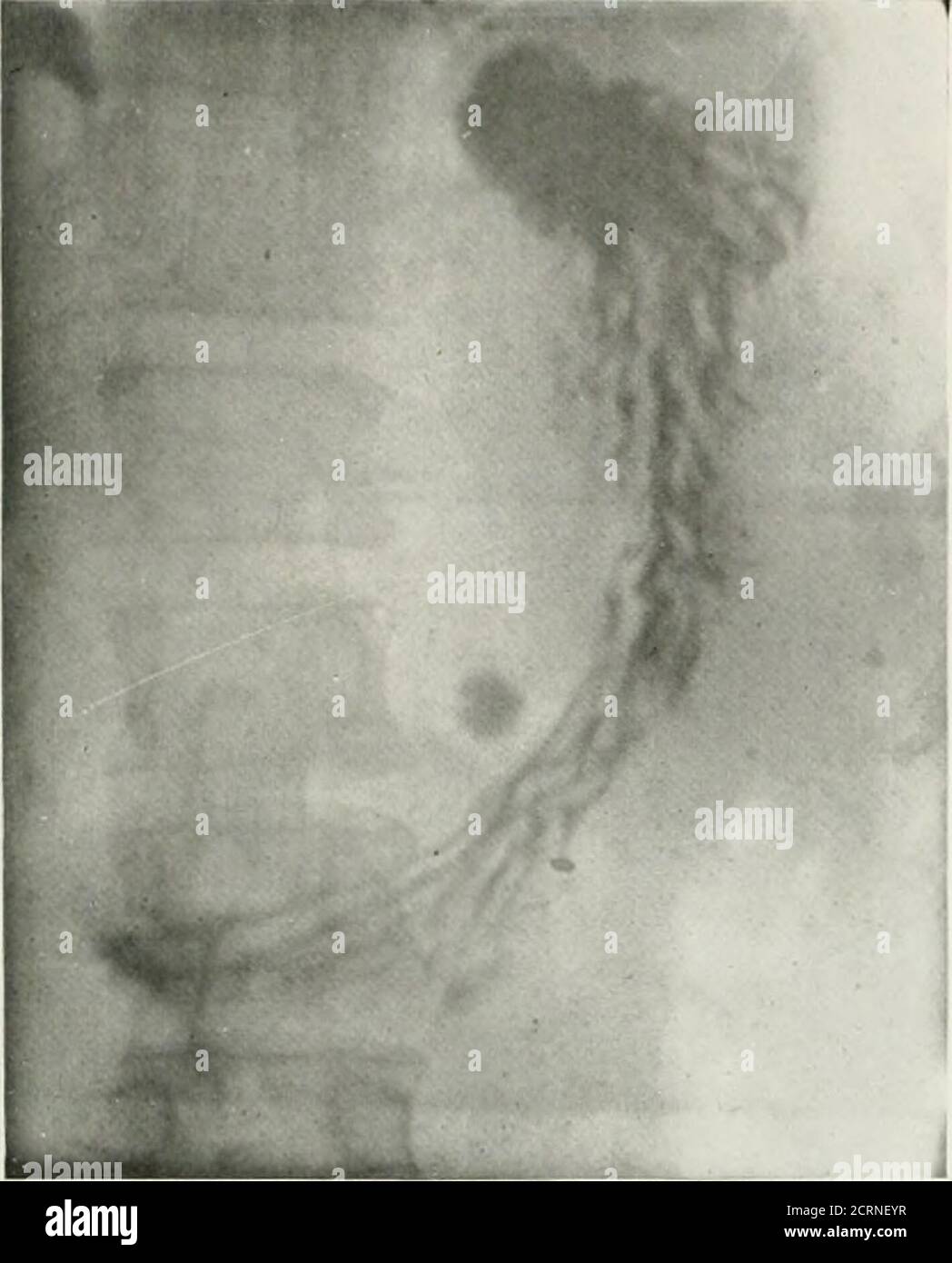 . The American journal of roentgenology, radium therapy and nuclear medicine . e wide arlati()n in the size and character of these folds, particularly during fluoros-copy. Later, It seemed that such study ofthe mucosa offered possibilities In demon-strating the earlier changes of the organiclesion and In the more detailed studyof those conditions already recognizedby the present day routine procedures.In this work the condition of the gastricmucosa has been studied chiefly throughconsideration of the rugae. Usually, thesefolds of mucous membrane arise in thecardia and extend downward towardst Stock Photo