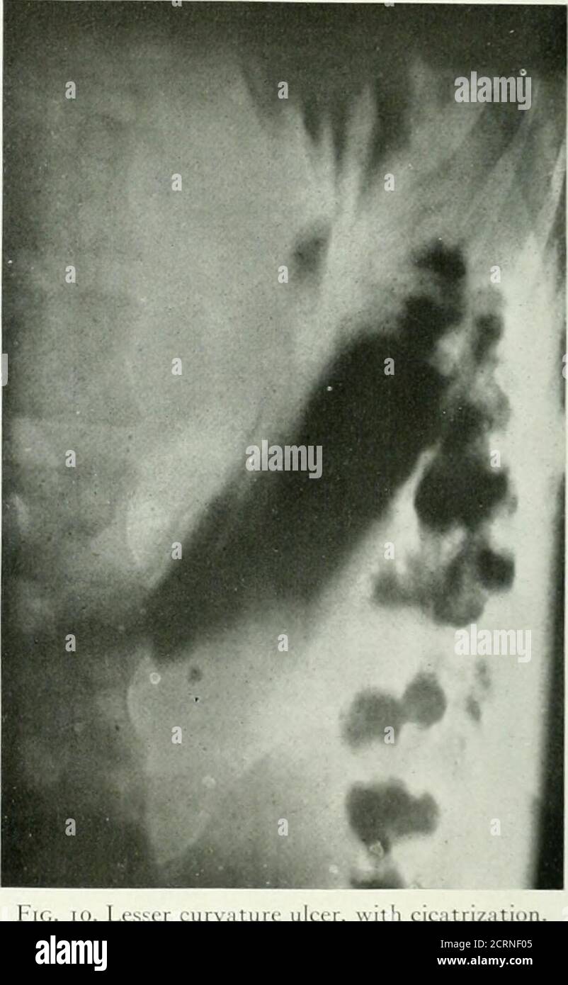 . The American journal of roentgenology, radium therapy and nuclear medicine . Fic. Q. Gastric ulcer of lesser curvature, demonstratingcollection of mixture in crater and rugae radiatingIrom same due to contracture at tfiis point; rugaeill-detincd on account of breathing. crater with radiation of the surroundingrugae from that point (Figs. 9, 10 and 11).If contraction has not occurred the rugaeextend as normally (Fig. 13). Again, therugae accompanying gastric ulcer maybe seen to be definitely enlarged, due tothe associated hypertrophic gastritis. Thismethod then oilers a more completeexaminati Stock Photo