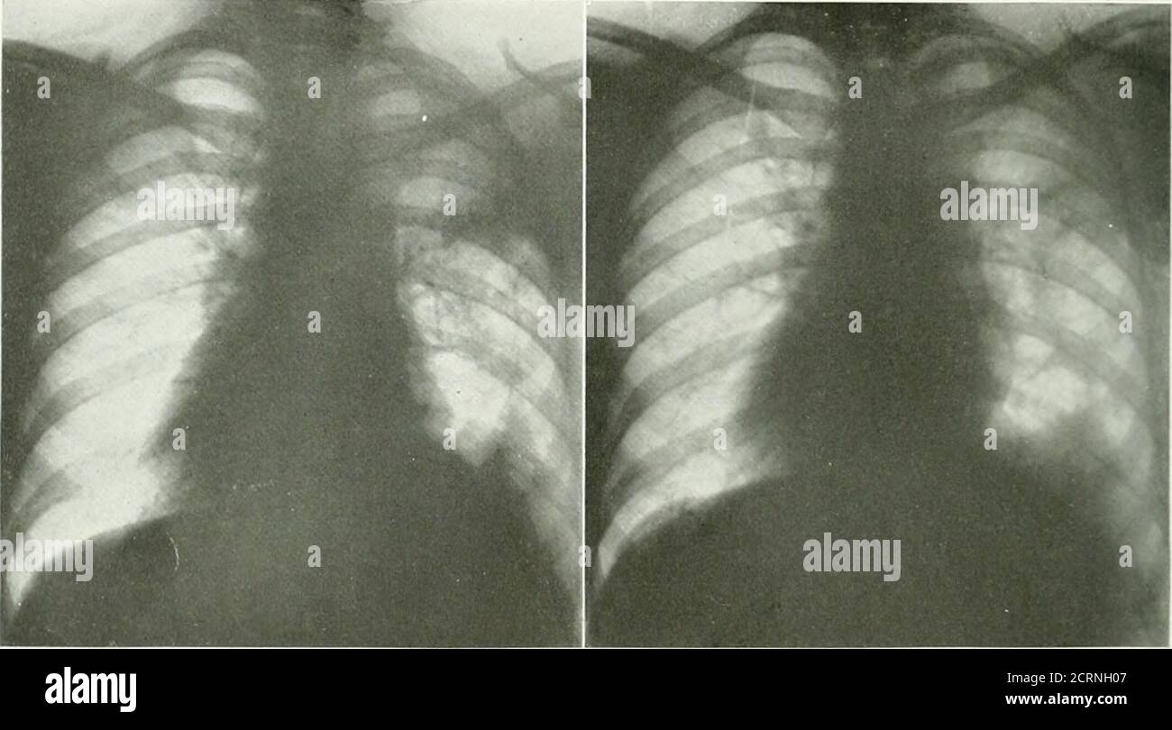 . The American journal of roentgenology, radium therapy and nuclear medicine . nd immobile and therehas been gradual retraction of the heartand mediastinal structures toward theright. There appears to be distinct fibrosisin the right lung (Fig. 6). The patient was lost to observationuntil May 23, 1922, when she reportedagain with an extensive local recurrencein the same location where the tumor wasbefore. She states that this began to appearin February, 1922. There is now a largecauliflower mass with bad odor. Examina- nied by cough and dyspnea; that this waspresumably due to extension of the Stock Photo