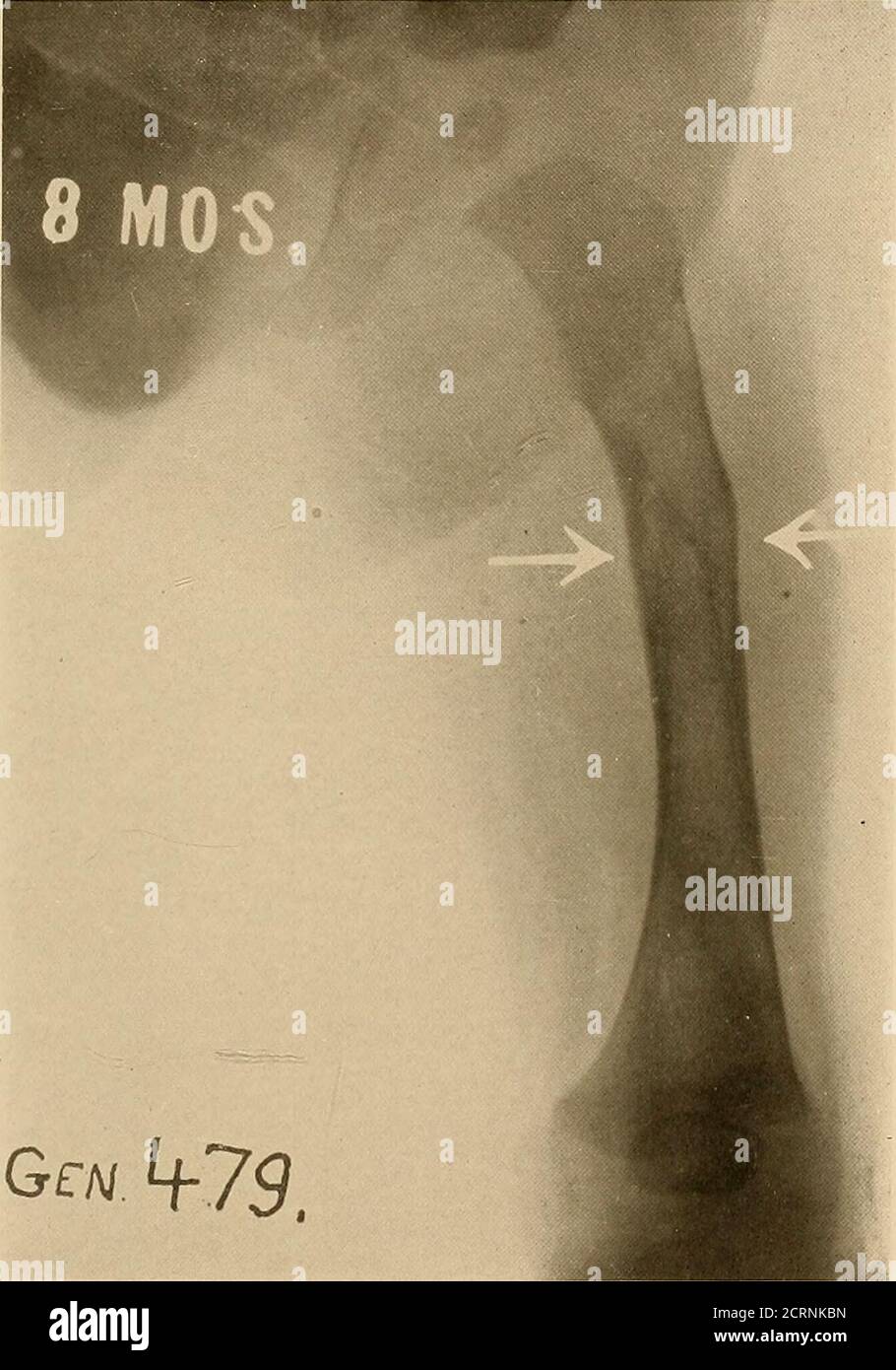 . Birth fractures and epiphyseal dislocations . Fig. 71.—Case 3. At the eighth month the anterior angular deformity hadbegun to assume the usual anterior curvature, characteristic of these frac-tures when the original anterior angulation has remained uncorrected.. Gf A/ ff 75. Fig. 72.—Case 3. The anterior view of the injured femur at the eighthmonth presented but slight abnormality. There was slight thickening, withoutward curvature, but the result from this point of view was satisfactory. 75 Stock Photo
