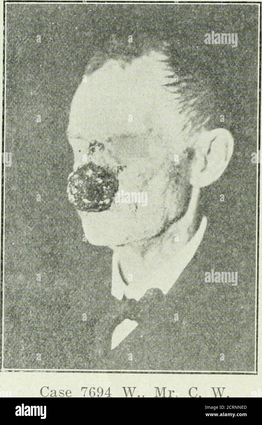 . Radium . Case 7694 W., Mr. C. W.Squamous Cell Epithelioma history of nose trouble. Eye, ear and throat history negative. Familyhistoi-y: Mothers sister died with carcinoma of the face. Father diedof pulmonary tuberculosis at the age of fifty-six. Other family history,negative. Social histoiy, negative. Examination: Nose appears en-larged in all dimensions and reddened. There is a shallow excavationon the end of the nose, just above the tip, and including the left lower. (694 W., Mr. C. W,December 15, 1917 I^ADIUM 67 Stock Photo