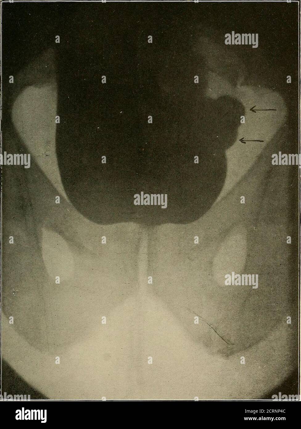 . A text-book of radiology . LARGE HYDRO-NEPHROSUS. The Pelvis of the kidney was injected with collargol before the radiograph was taken. PROPERTY OFVICTOR X-RAY CORPORATION PLATE XXV.. BLADDER. After injection with an emulsion of bismuth to show presence and position of sacculi. URINARY CALCULI. 193 Sometimes a calculus gets in line with a transverseprocess—a local alteration in the density of a process isalways suspicious, but if a stereoscopic pair is madethe difficulty will soon be cleared up. A triangular shadow in the renal area with point down-wards may indicate a stone plugging the ent Stock Photo