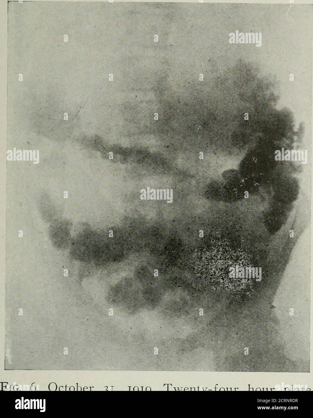 . The American journal of roentgenology, radium therapy and nuclear medicine . FiG. 5. October 30, 1919. Anterior-posterior view,showing gastro-enterostomy. practically twice the size. At the same timea quantity of the barium mixture was ob-served spreading out through the gastricarea and assuming the gastric shape and Gastrocolic Fistula 519 appearance of rugae. A plate was made im-mediately which confirmed this observation.The opening from the colon to the stomach. 6. October 31, 1919. Twenty-four hour plate. Three days later, after a thorough ca-tharsis and preliminary cleansing enema, theb Stock Photo