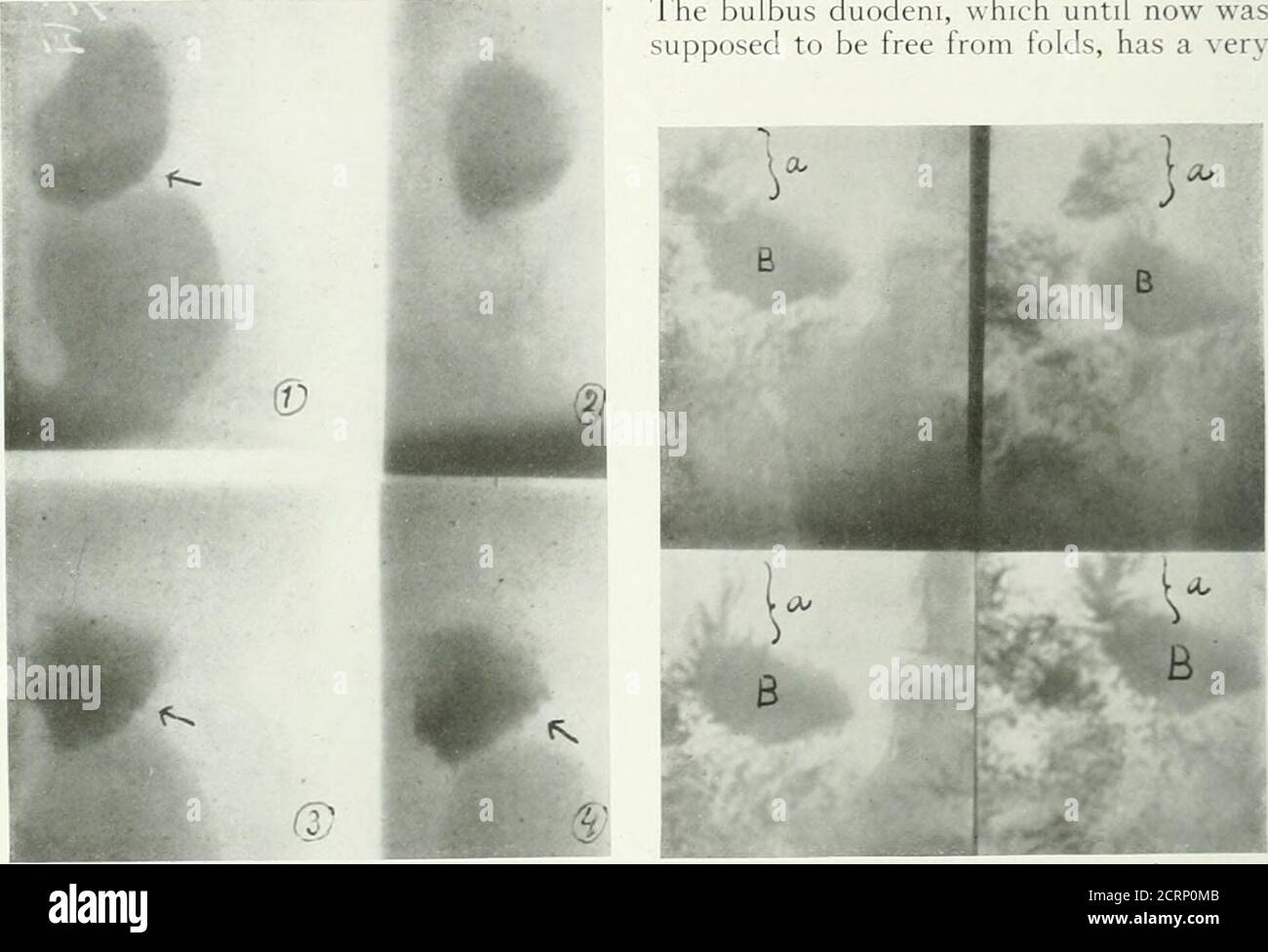 . The American journal of roentgenology, radium therapy and nuclear medicine . sfree from folds of the mucous membrane,and diflerent anatomical forms are attrib-uted to the valvulae conniventes of the 92 Mechanism of Movement of the Mucous Membrane of the Digestive Tract duodenum and the small intestines. Allthought of a change of form of the foldsof the mucous membrane, on account of amovement of their own, has been com-pletely ignored. But a closer study of thestructure of the relief of the folds of themucous membrane of the intestines onanatomical preparations and on the livingintestines wi Stock Photo
