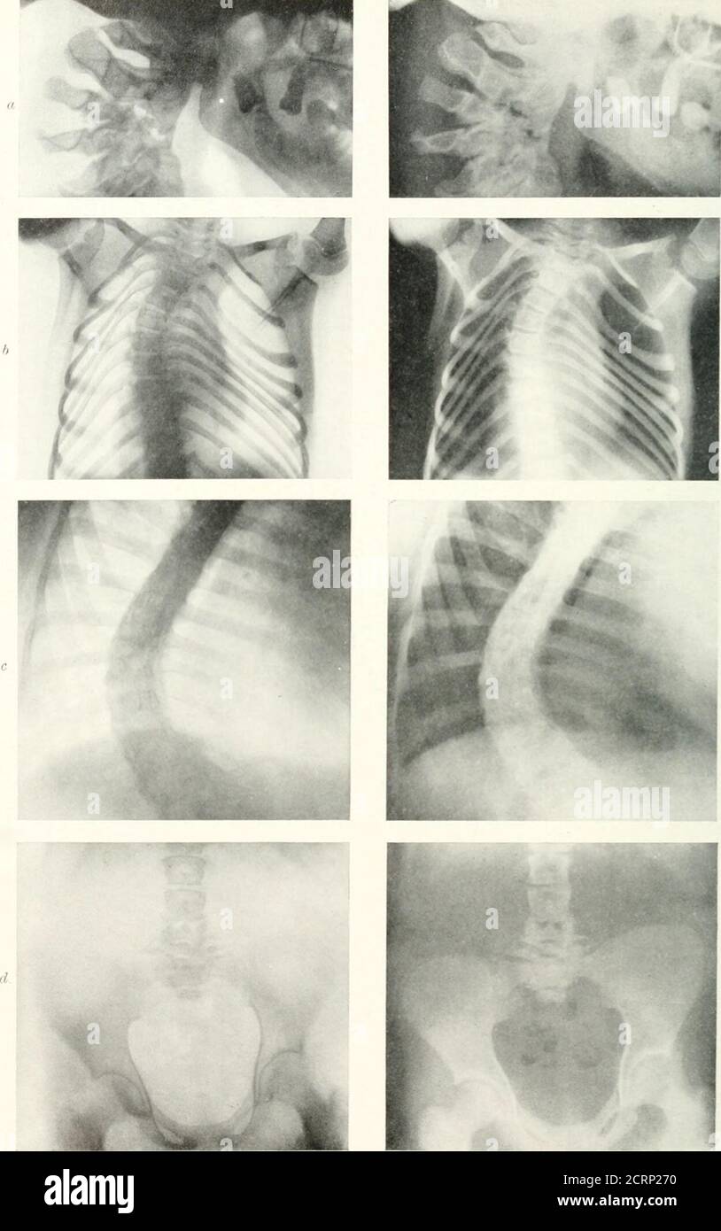 Foreign bodies x ray hi-res stock photography and images - Alamy