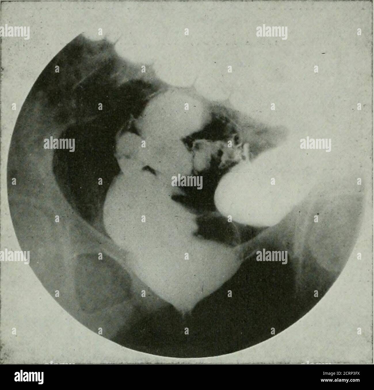 . The American journal of roentgenology, radium therapy and nuclear