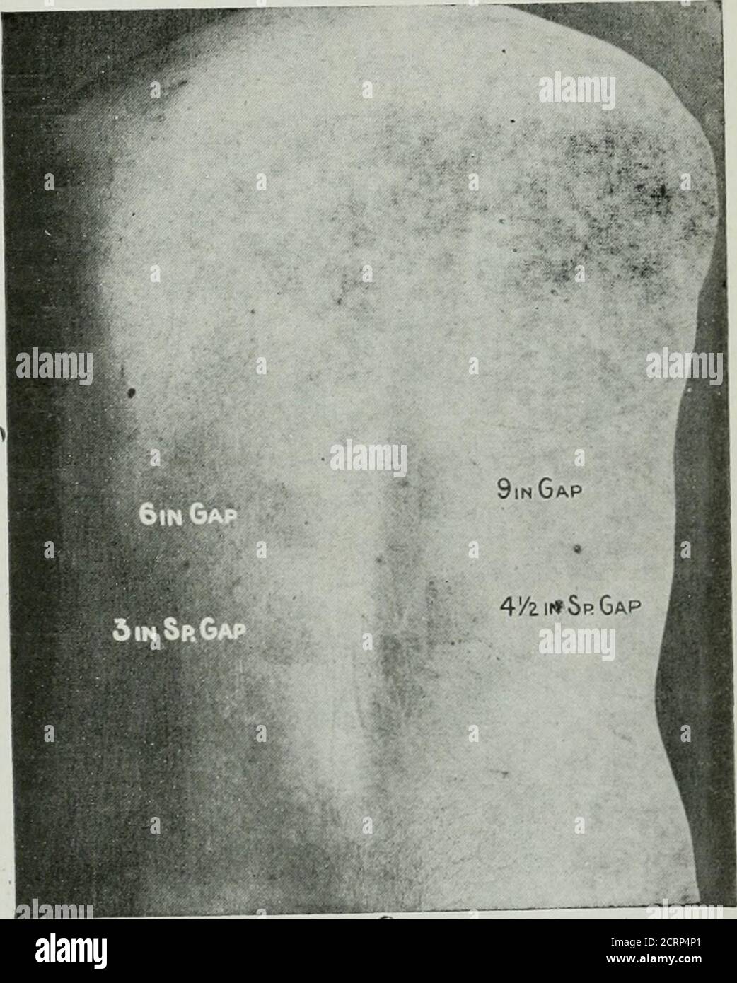 . The American journal of roentgenology, radium therapy and nuclear medicine . actors necessi-tated maintaining three of them constantthroughout the exposure, and varying theone under investigation. Thus, maintaining3 Sp G 3 M A for five minutes at a distanceof 8 inches produced an erythema in theusual time, ten to fourteen days, over an areaof the chest which happened to be coveredwith hair. The third week after exposure thehair came out and showed no signs of return-ing at the end of six months. Another areaof the chest was exposed and given 3 Sp G3 M A at a distance of 8 inches for four min Stock Photo