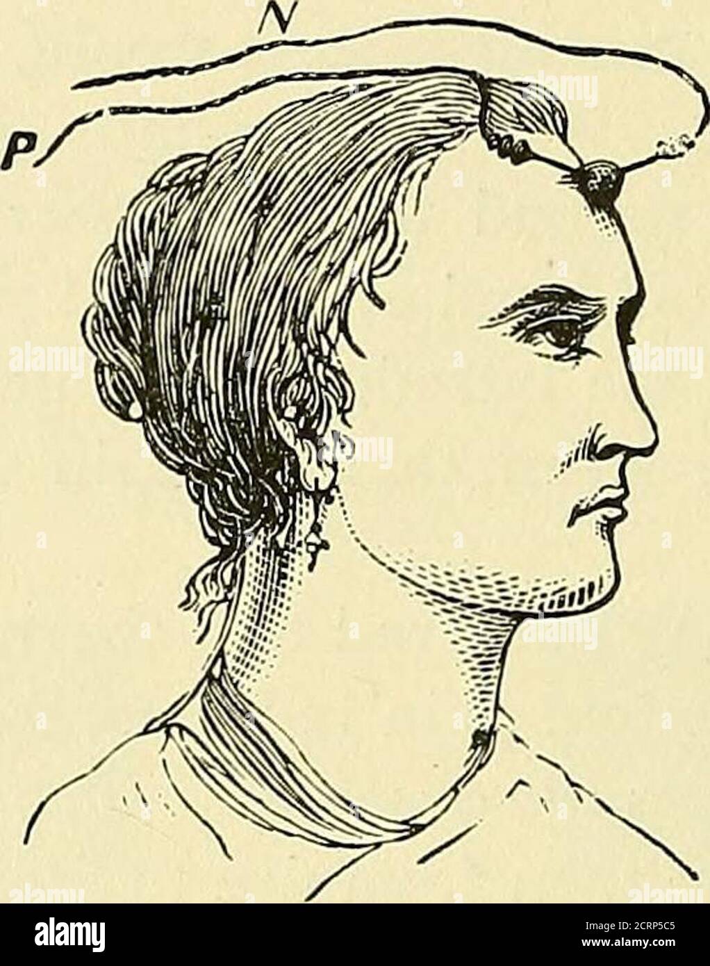 . The medical and surgical uses of electricity. . fthe treatment. Afterwards they recede more and more slowly; and, evenin those cases where the ure is complete, the last quarter will require* Diseases of the Skin, vol. iv., section A. 56o ELECTRO-SURGERY. more treatment than the first three-quarters. This is true of all hardgrowths that are treated by electricity. Massey * reports the cure of a cystic goitre of large size—35 to 40milliamperes at first; later, free incision, with application of positive gold-bulb electrode to inner wall of tumor, 50 to 100 milliamperes. Green *reports favorabl Stock Photo