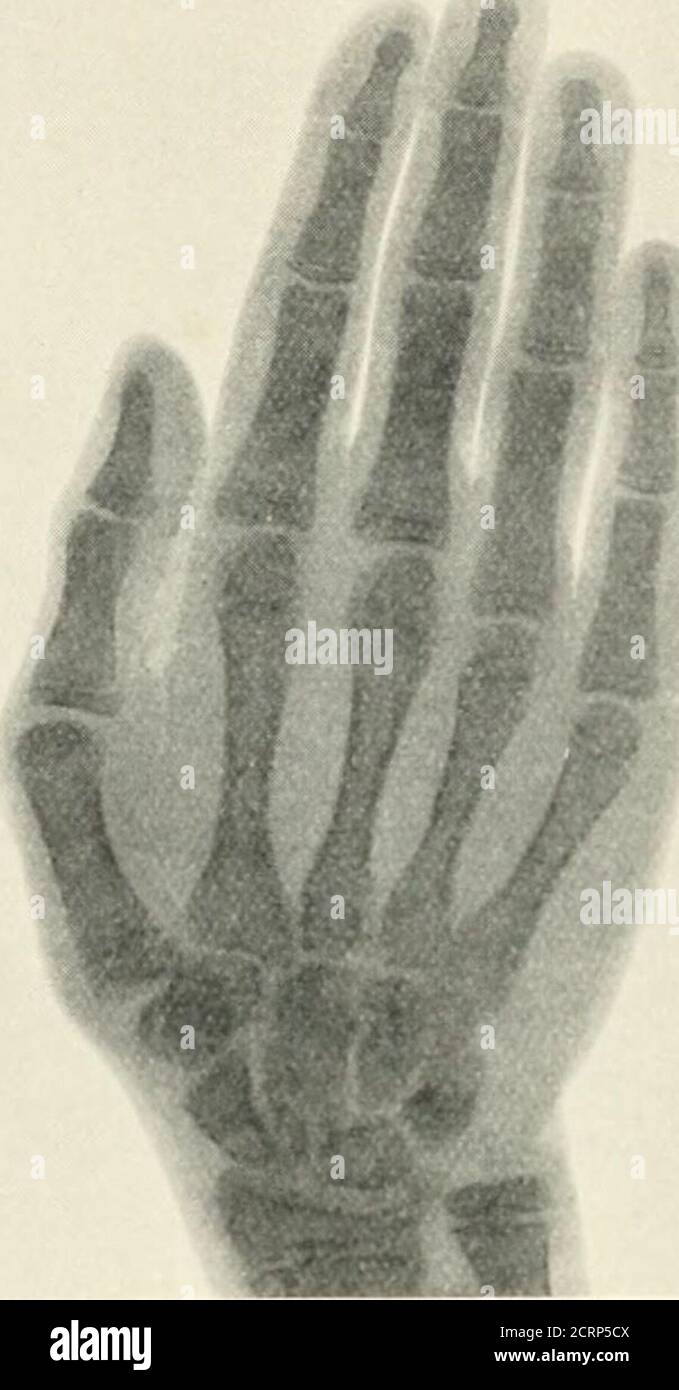 . Radiography, x-ray therapeutics and radium therapy . Fig. 121.—Hand ...