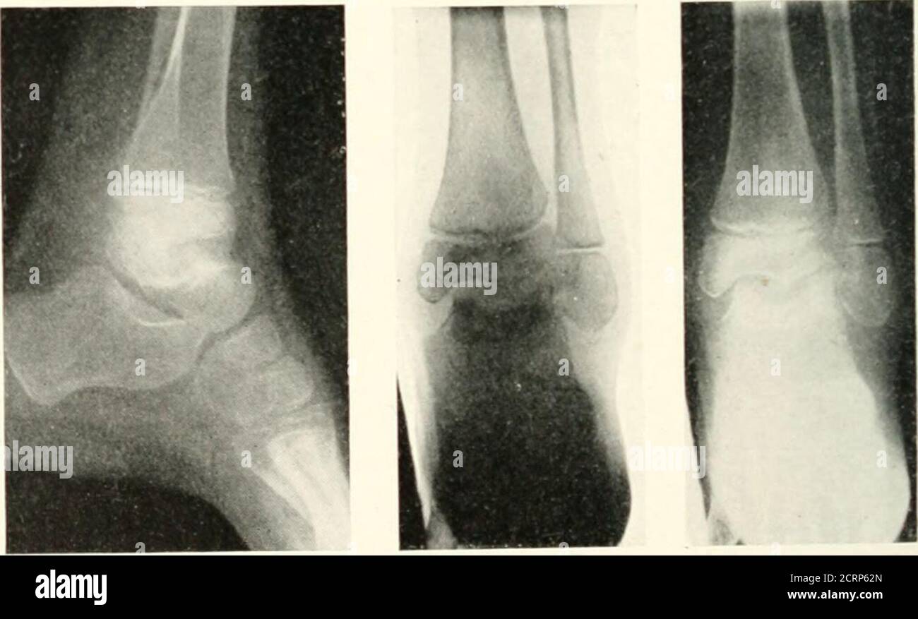 Epiphyseal plate hires stock photography and images Alamy