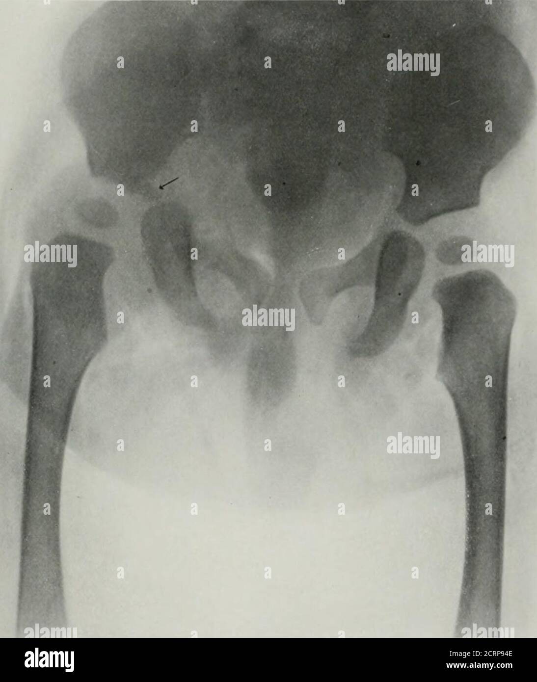 Child Rentgen Capsule of hip joint hi-res stock photography and images - Alamy