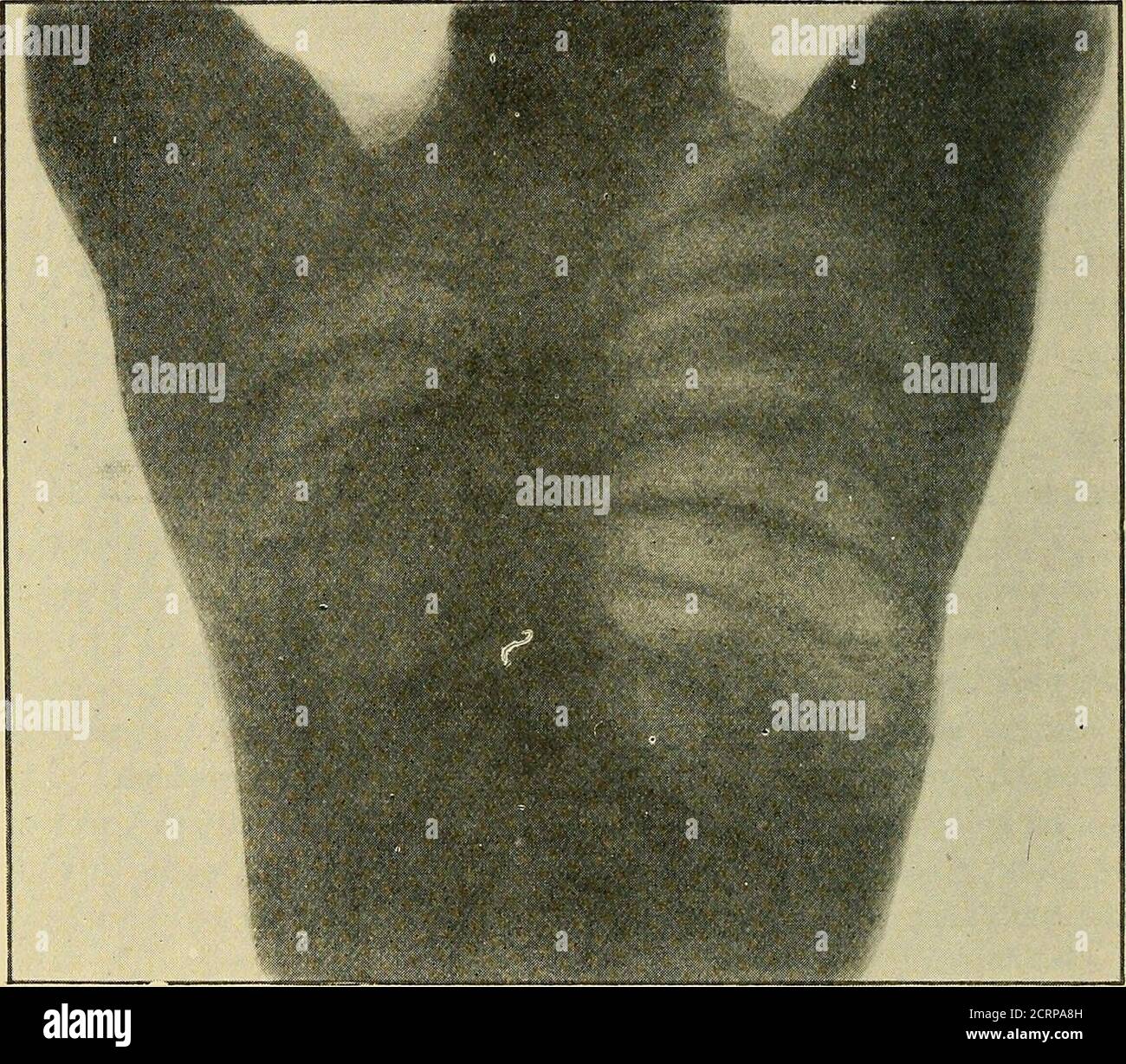 . The Röntgen rays in medical work . left side. Theright border of the ...