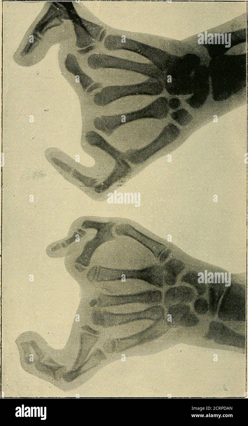 . The Röntgen rays in medical work . Fig. 124.—Congenital Absence of ...