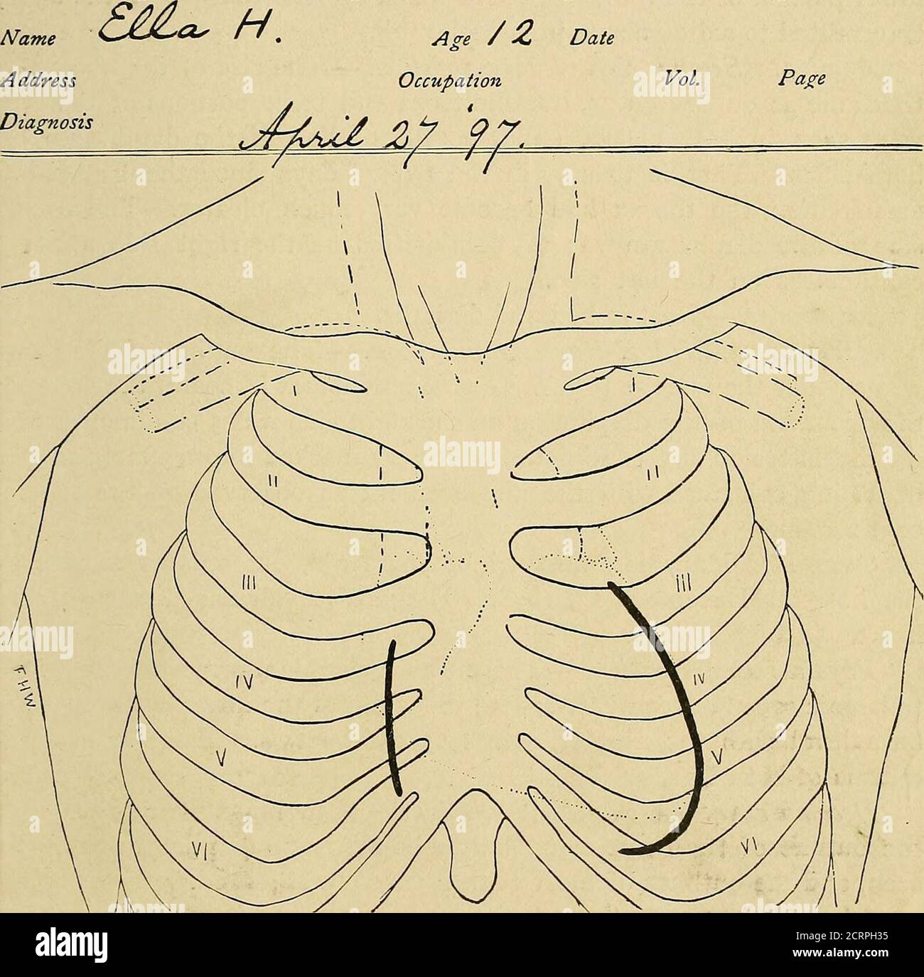 Enlarged heart x ray hires stock photography and images Alamy