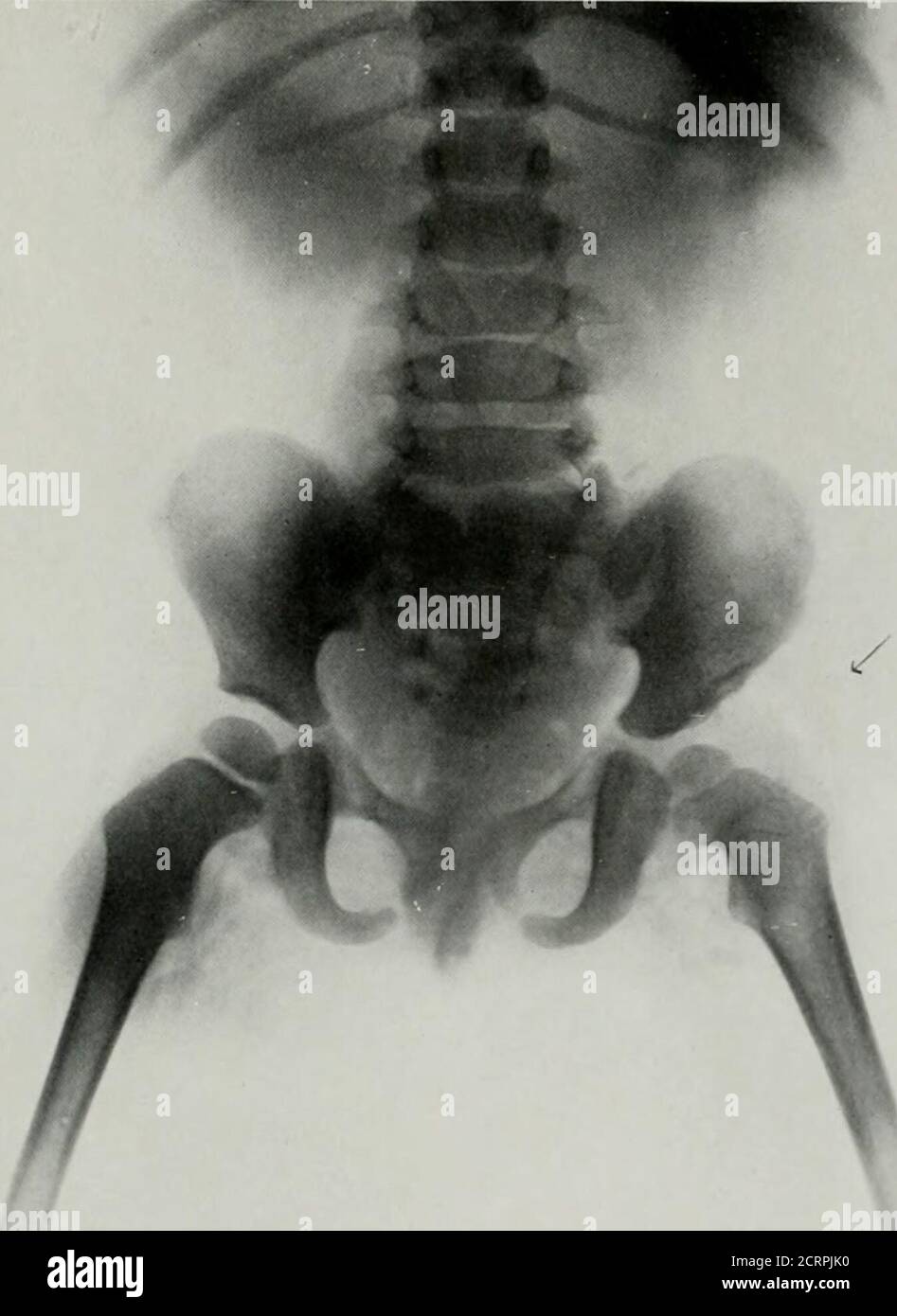 Child Rentgen Spina bifida occulta High Resolution Stock Photography and Images - Alamy