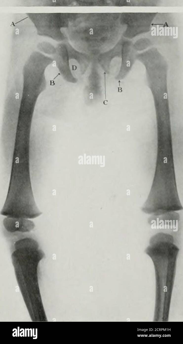 Fibula e tibia hi-res stock photography and images - Alamy