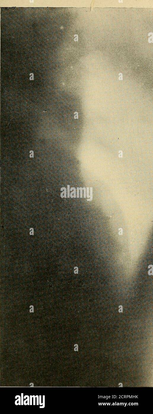 . The Roentgen rays in medicine and surgery as an aid in diagnosis and as a therapeutic agent : designed for the use of practitioners and students . how a variation in the thickness of the chest wall may alterthe percussion note. This note had misled him in determining part ofthe cardiac outline. A radiograph was also taken of this patient, which shows theappearances seen from the side. (See Fig. 125.) Physical Signs of Tuberculosis hidden by Emphysema; AbnormalCondition of Lungs seen by X-Rays. — The same cause that makes itdifficult or impossible to recognize the cardiac area in pulmonary em Stock Photo