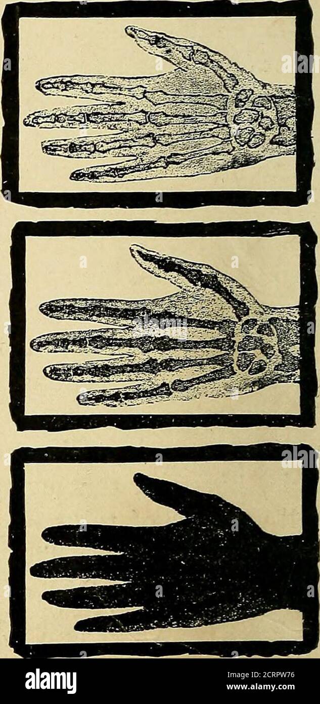 . The Roentgen rays in medicine and surgery as an aid in diagnosis and ...