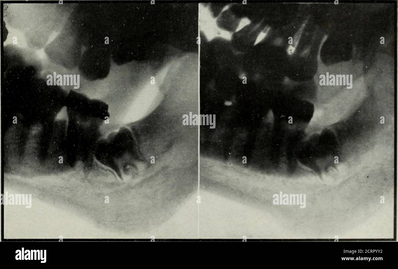 . Elementary and dental radiography . Fig. 343. No stereoscopic effect at all is obtained with the radiographs mounted as in this figure. Special Cccbnic for Dental Stereo- Kadiograpby. We now come to a more definite considerationof dental stereoscopic radiography. Stereoradio-graphs of the lower teeth may be made on platesusing the plate changer illustrated in Fig. 327. Fig.344 is such a stereoradiograph. Fig. 344 was made from the pose illustrated in Fig. 330.. Fig. 344. Though the stereoscopic effect is not very good tlie figure is representative of wliatcan be done by the method employed t Stock Photo