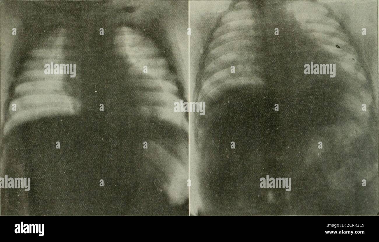 Walnut On Radiograph . Radium . Fig. 4. Case 2. Before Treatment. One Week Later.. Vig. 5 ...