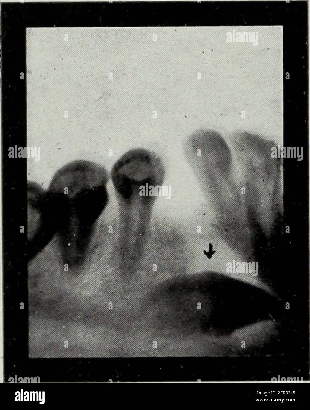 Elementary And Dental Radiography Tion Ery Escent Proved Proved Data Manic Depressive Type 11 9 5 2 2 Dementia Precox 10 8 5 I 2 Psychosis 4 Elementary And Dental Radiography Tion Ery Escent Proved Proved Data Manic Depressive Type 11 9 5 2 2 Dementia Precox 10 8 5 I 2 Psychosis 4
