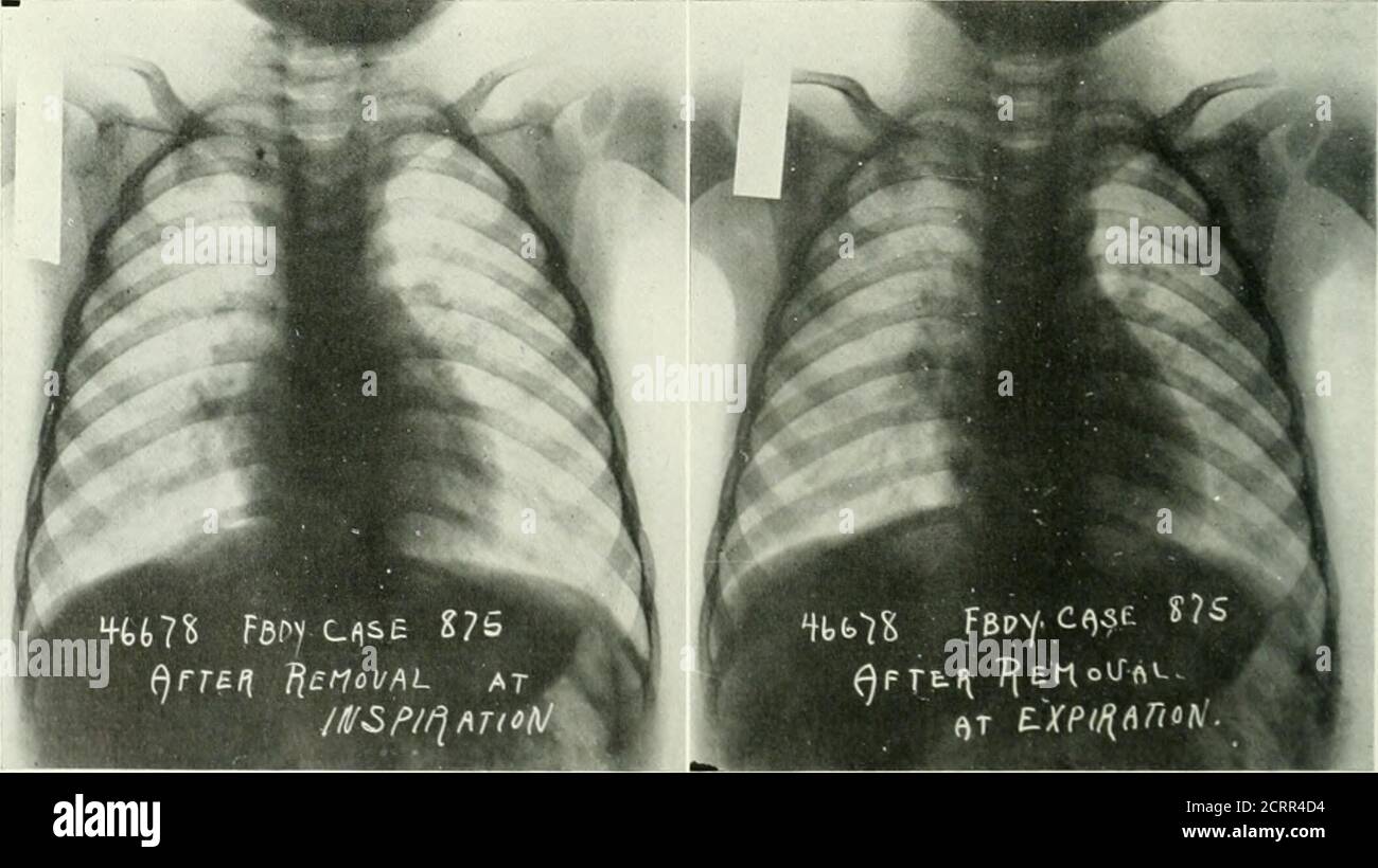 Compensatory emphysema hires stock photography and images Alamy