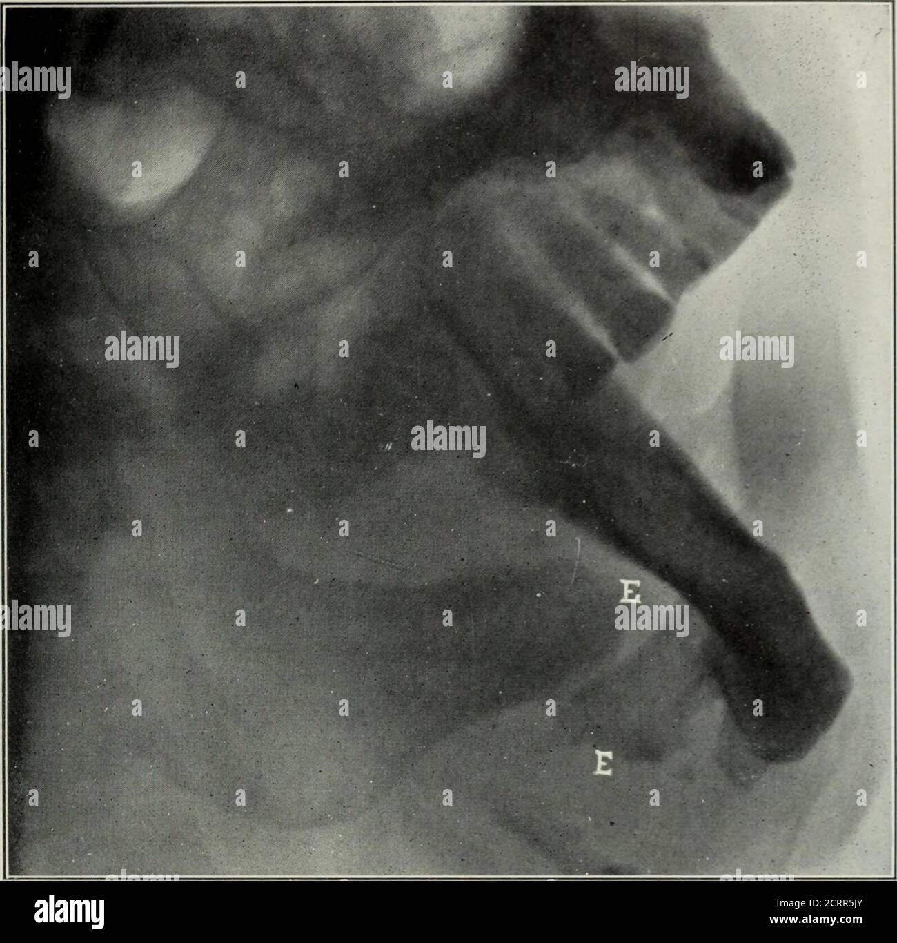 . Elementary and dental radiography . Fig. 268. Same as Fig. 267, with