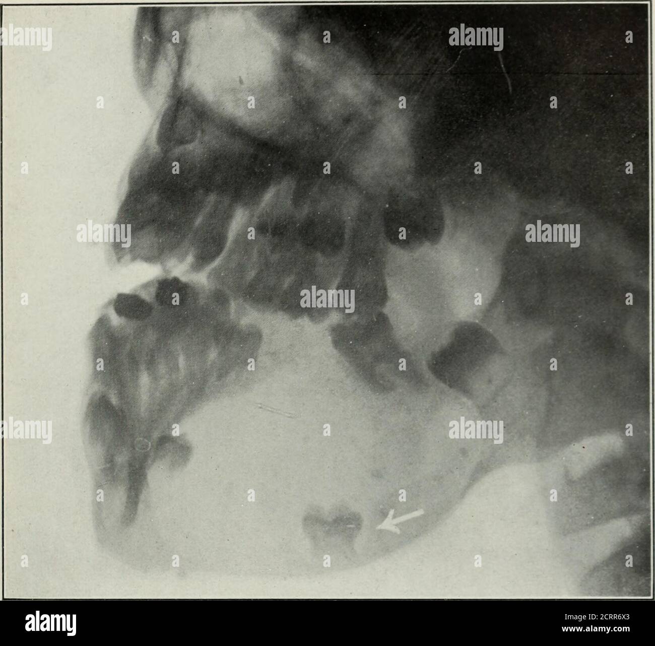 . Elementary and dental radiography . Fig. 256. Bone cyst of the lower