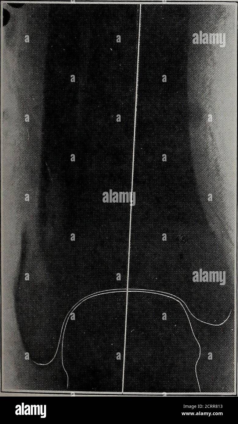 . American quarterly of roentgenology . No. 4. Potts Fracture of the ankle. Takenafter attempted reduction. More than three-fourths of the astragalus is external to theplotted line, indicating that further reductionis necessary. No. 4 No. 5. Fracture of the lower end of thefibula after reduction. It will be noted thatthe anatomical reduction of the fibula appearsto be very good but the position of the astra-galus is not satisfactory and if the ankle wereleft in this position there would be an ab-normal line of weight-bearing force. Thisillustrates the necessity of interpretatingX-ray negatives Stock Photo