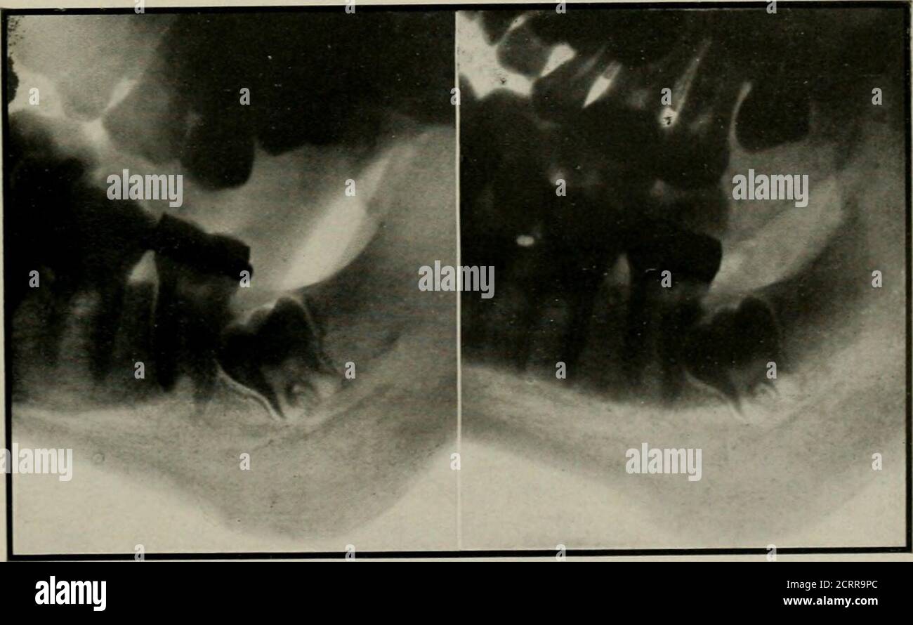 . Elementary and dental radiography . Fig. 343. No stereoscopic effect at all is obtained with the radiographs mounted as in this figure. We now come to a more definite considerationof dental stereoscopic radiography. Stereoradio-graphy of the lower teeth may be made on platesusing the plate changer illustrated in Fig. 327. Fig.344 is such a stereoradiograph. Fig. 344 was madefrom the pose illustrated in Fig. 330. Special teebnicfor Dental Stereo-Radiography.. Fig. 344. Though the stereoscopic effect is not very good the figure is representative of whatcan be done by the method employed to mak Stock Photo