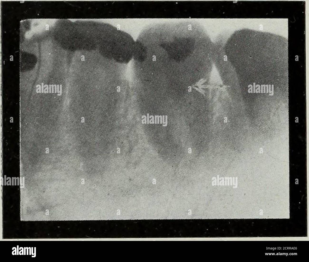 . Elementary and dental radiography . molar. 14. Tn Cases of Pulp ...