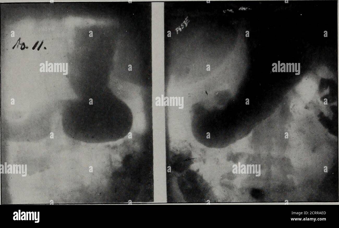 Peristaltic waves hires stock photography and images Alamy