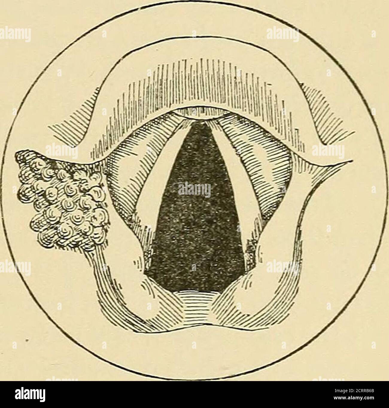 . Diseases of the nose and throat . Fig. 132.—Chondroma of the epiglottis. (After Bos-worth.). Fig. 133.—Angioma of the leftaryepiglottic fold. (After Bos-worth.) as follow: A papilloma is soft and movable by inspiration and expira-tion. When single, it is a gray or pink, and, as a rule, situated uponthe anterior half of the vocal cord. It is usually sessile, although thebase is not very broad. When multiple, as in children, the little, softmasses may have a brighter hue. and the whole length of the cordsmay be studded with them. I have seen the latter condition in a girlof eighteen years. A f Stock Photo