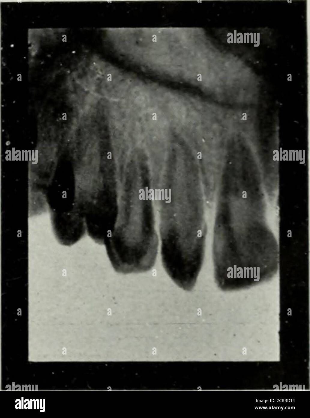 Tooth with temporary filling for nerve destruction and pulpitis treatment.  Stomatology Stock Photo - Alamy